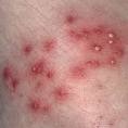 Preventing Pimples and Acne