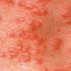 pictures of scabies